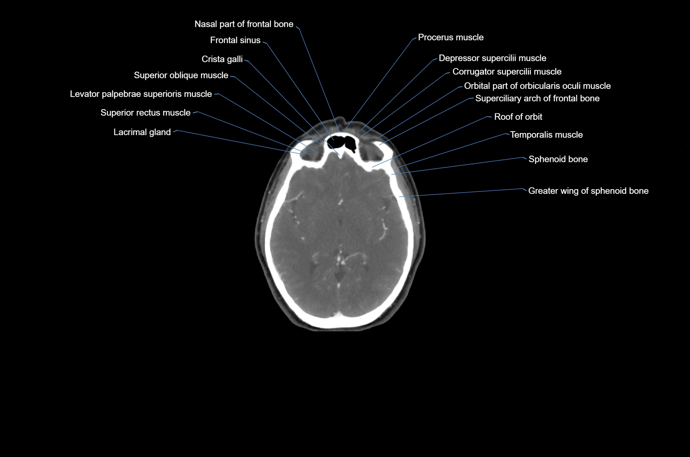 CT Neck axial cross sectional anatomy radiology image-img-00001-00001.webp